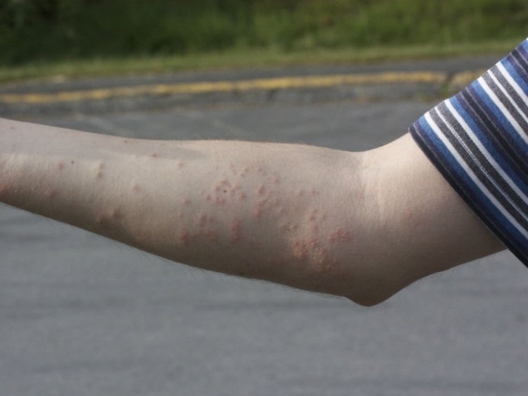 Bedbug bites